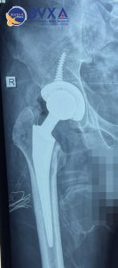 Hình ảnh cận lâm sàng của bệnh nhân sau phẫu thuật thay khớp háng