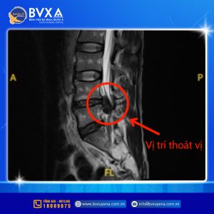 Hình ảnh MRI cho thấy vị trí thoát vị