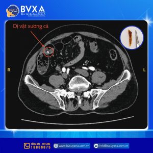 Hình ảnh cận lâm sàng cho thấy xương cá đâm xuyên thành manh tràng
