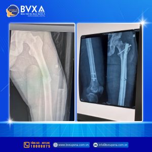 Hình ảnh cận lâm sàng sau khi phẫu thuật có sự hỗ trợ bởi màn hình tăng sáng