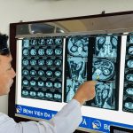 LẤY SỎI SAN HÔ CÓ KÍCH THƯỚC LỚN BỆNH NHÂN 64 TUỔI