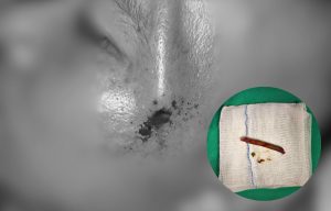 Hình ảnh bệnh nhân bị cành cây đâm xuyên thái dương