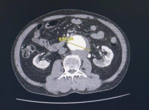 Hình ảnh MRI của ông cụ bị phình động mạch chủ bụng