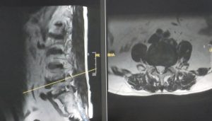 Hình ảnh MRI cho thấy vị trí thoát vị đĩa đệm