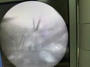 Hình ảnh trên máy C-arm quan sát trong quá trình phẫu thuật nội soi cột sống thức tỉnh