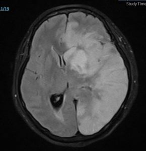 Hình ảnh phim MRI ghi nhân bệnh nhân bị nhồi máu não diện rộng bán cầu bên trái