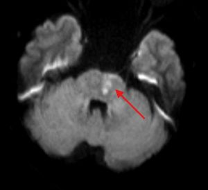 Hình ảnh tổn thương nhồi máu cầu não trái trên phim MRI của bệnh nhân đột quỵ