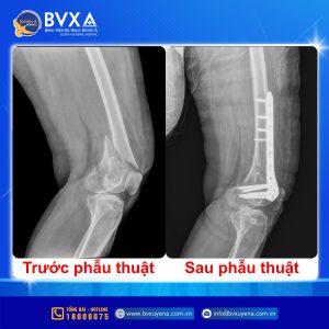 Hình ảnh X-Quang trước vào sau phẫu thuật vì chấn thương do tai nạn giao thông