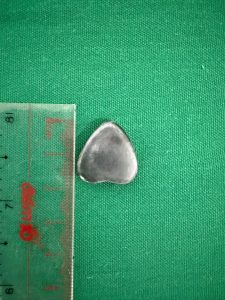 Hình ảnh dị vật nam châm hình trái tim được lấy ra
