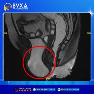 Hình ảnh cận lâm sàng cho thấy bệnh nhân bị sa sàn chậu độ III, sa bàng quang độ III và sa tử cung độ II