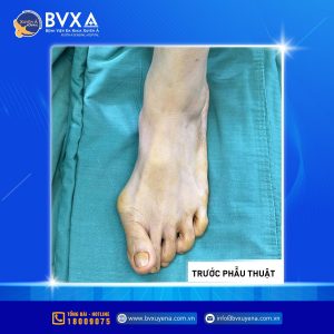 Hình ảnh ngón chân vẹo trước khi phẫu thuật