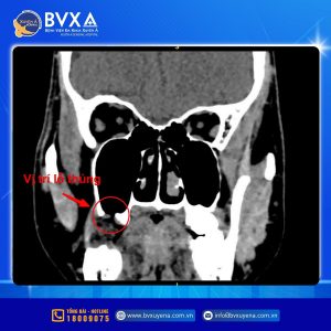 Hình ảnh CT cho thấy bệnh nhân thủng xoang hàm sau khi nhổ răng khôn