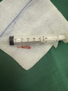 Hình ảnh đoạn xương mỏm trân sau khi cắt bỏ