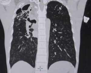 Hình ảnh CT phổi cho thấy bệnh nhân bị vỡ mạch máu phế quản