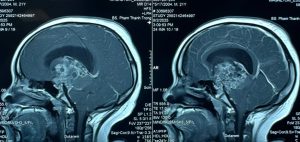 Hình ảnh MRI khối u sọ hầu