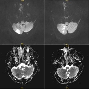 Hình chụp MRI của bệnh nhân trong khi đá banh bị đột quỵ