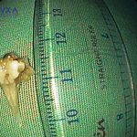 SUÝT THỦNG PHẾ QUẢN VÌ MẢNH XƯƠNG CÁ ĐI LẠC