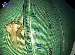 HÌnh ảnh mảnh xương cá sau khi được lấy ra