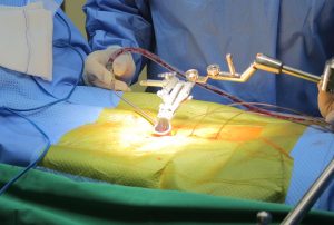 Hình ảnh quá trình phẫu thuật thoát vị đĩa đệm