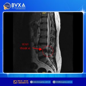 Hình ảnh MRI cho thấy vị trí thoát vị đĩa đệm