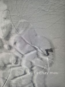 Hình ảnh vị trí chảy máu