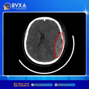 Hình ảnh MRI não của nữ sinh 15 tuổi gặp tai nạn vì tà áo dài cuốn vào bành xe