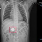 GẮP THÀNH CÔNG ĐỒNG XU GAME 22MM TRONG DẠ DÀY BÉ TRAI 6 TUỔI