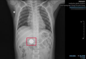 Hình ảnh cận lâm sàng cho thấy đồng xu trong thực quản