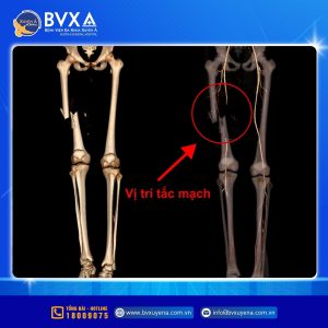 Hình ảnh cận lâm sàng cho thấy phan xương gãy