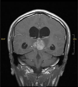 Hình ảnh MRI khối u vùng tuyến tùng