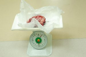 Khối u vú được lấy ra sau mổ nặng 2kg