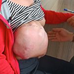 CẮT BỎ KHỐI U VÚ TO NHƯ TRÁI DƯA HẤU CHO BỆNH NHÂN CAMPUCHIA