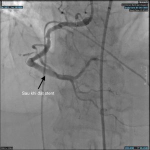 Mạch máu sau khi đặt stent