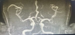 Hình ảnh phim MRI của bệnh nhân bị "đột quỵ thức giấc"