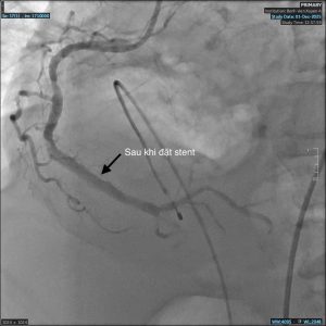 Sau can thiệp stent, tái thông được mạch máu