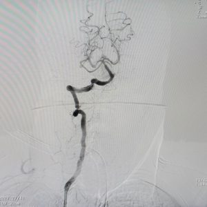 Sau khi can thiệp nội mạch