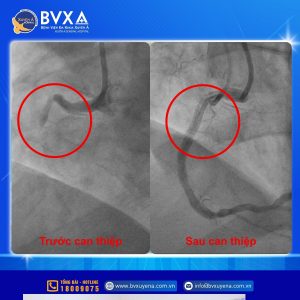Hình ảnh trước và sau can thiệp