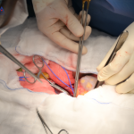 KHÔNG CÒN LÀ BỆNH TUỔI GIÀ: CHÀNG TRAI 25 TUỔI SUY THẬN NẶNG, PHẢI GHÉP THẬN ĐỂ GIỮ MẠNG SỐNG