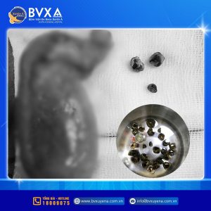 Hình ảnh sỏi được lấy ra