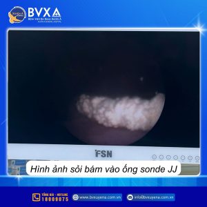 Hình ảnh sỏi bám vào ống Sonde JJ