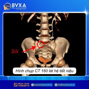 Hình ảnh CT 160 lát hệ tiết niệu của bênh nhân bị sỏi niệu quản