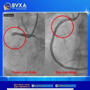 Hình ảnh trước và sau can thiệp điều trị nhồi máu cơ tim
