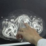 GIÀNH LẠI SỰ SỐNG CHO CỤ BÀ BỊ VỠ BÀNG QUANG TRONG PHÚC MẠC TỰ PHÁT HIẾM GẶP