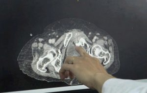 Hình ảnh CT vị trí vỡ bàng quang