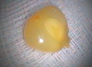 Hình ảnh hạt bắp khiến người phụ nữ suy hô hấp nguy kịch