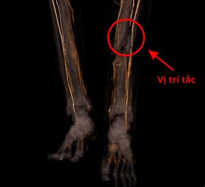 Hình ảnh CT mạch máu