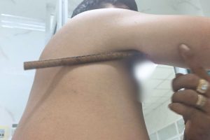 Hình ảnh bệnh nhân bị thanh sắt đâm xuyên cánh tay lúc mới vào viện