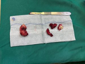 Hình ảnh u khi lấy ra ngoài