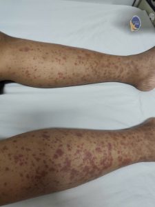 Hình ảnh vết ban lúc mới vô viện