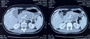 Hình ảnh phim CT khối u tụy